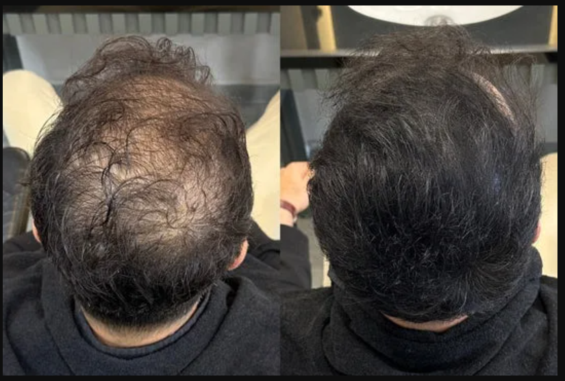BATCI Hair Concealer – خافي فراغات الشعر الطبيعي للرجال والنساء (يدوم حتى 15 يوم)